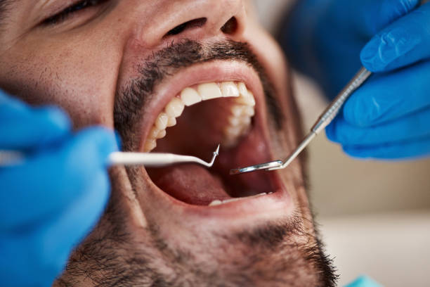 Best Emergency Wisdom Tooth Extraction in Port Norris, NJ